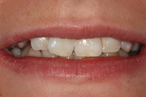 Uśmiech pacjentki przed leczeniem