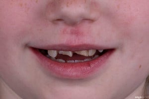 Złamany uśmiech dziecka (8 of 8)