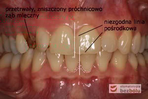 Status zębowy wyjściowy Status zębowy wyjściowy
