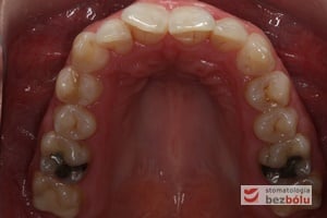 Kształt łuku górnego przed leczeniem