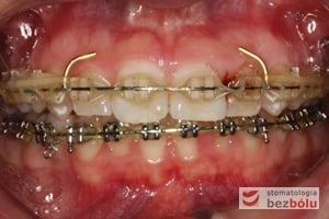 Zastosowanie łuków typu posted oraz retainera wyciągów poziomych w celu retrakcji odcinka przedniego