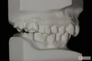 Warunki okluzyjne na modelach gipsowych przed leczeniem Warunki okluzyjne na modelach gipsowych przed leczeniem