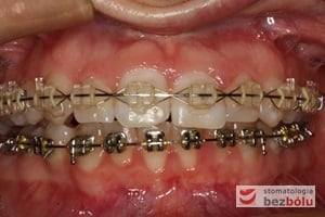 Aktywna faza leczenia z zastosowaniem odpowiedniej sekwencji łuków niti i stalowych