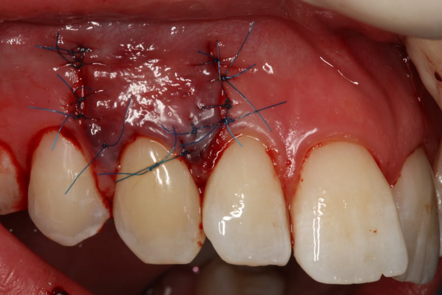 stop_uciekajacym_dziaslom_min