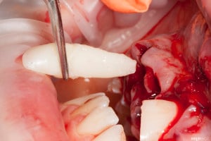 Złamany uśmiech dziecka (3 of 8)