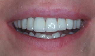 Pozytywna przemiana uśmiechu pacjenta Pozytywna przemiana uśmiechu pacjenta