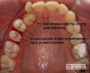 Widok okluzyjny łuku górnego Widok okluzyjny łuku górnego