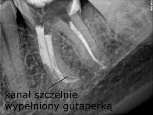 Usunięcie narzędzia umożliwiło zdezynfekowane kanału i szczelne wypełnienie go gutaperką - Sięgnąć gdzie wzrok nie sięga