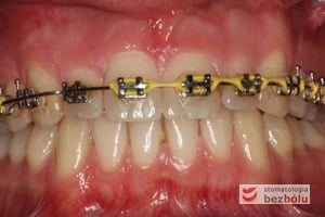 Ustalenie precyzyjne linii pośrodkowej