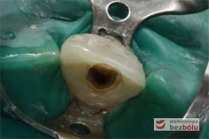 Kanał zęba przygotowany do wypełnienia Kanał zęba przygotowany do wypełnienia