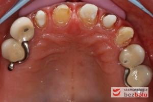 Opracowane filary protetyczne - oszlifowane zęby własne jako filary na których osadzone zostaną finalne korony porcelanowe Opracowane filary protetyczne - oszlifowane zęby własne jako filary na których osadzone zostaną finalne korony porcelanowe