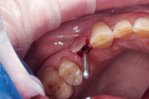 Kontrola równoległości preparacji do sąsiednich zębów