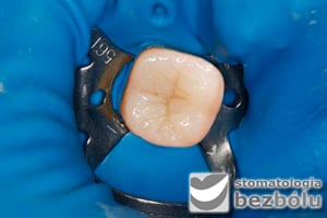 Koferdam wokół wypełnienia typu onlay Koferdam wokół wypełnienia typu onlay