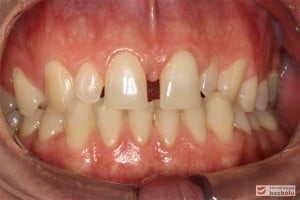 Warunki zgryzowe przed leczeniem Warunki zgryzowe przed leczeniem