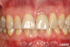 Warunki zgryzowe od frontu uzyskane po leczeniu Warunki zgryzowe od frontu uzyskane po leczeniu