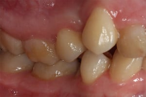 Warunki zgryzowe przed leczeniem - strona prawa Warunki zgryzowe przed leczeniem - strona prawa