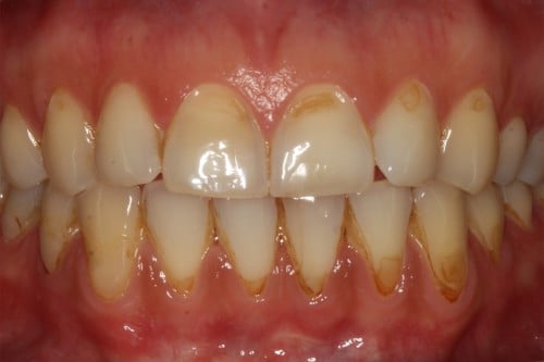 Jak chronić zęby? Kwasowa erozja szkliwa Kwasowa erozja szkliwa spowodowana nadmiernym spożyciem napojów izotonicznych