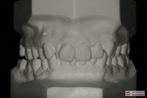 Modele gipsowe obrazujące zgryz przed leczeniem Modele gipsowe obrazujące zgryz przed leczeniem