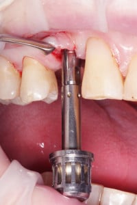 Wprowadzenie implantu