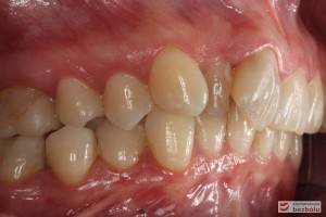 Warunki zgryzowe po stronie prawej przed leczeniem Warunki zgryzowe po stronie prawej przed leczeniem