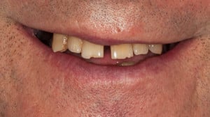 Stan wyjściowy - uśmiech pacjenta.