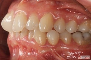 Warunki zgryzowe przed leczeniem - strona lewa