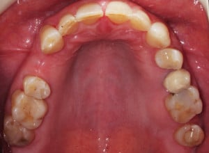 Sytuacja wewnątrzustna przed zabiegiem - łuk górny