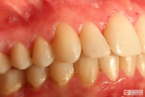 Warunki zgryzowe po leczeniu - strona prawa