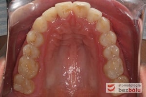 Kształt łuku górnego po leczeniu, widoczne uszeregowanie zębów siecznych oraz wprowadzenie do łuku czwórki górnej prawej będącej w zgryzie przewieszonym