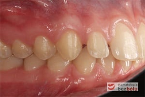 Zgryz pacjentki po zakończonym leczeniu ortodontycznym - strona prawa Zgryz pacjentki po zakończonym leczeniu ortodontycznym - strona prawa