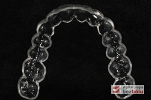 Szyna termoformowalna jako pozycjoner do skorygowania detali ustawienia zębów