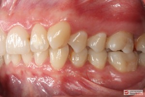 Warunki zgryzowe po stronie lewej przed leczeniem Warunki zgryzowe po stronie lewej przed leczeniem