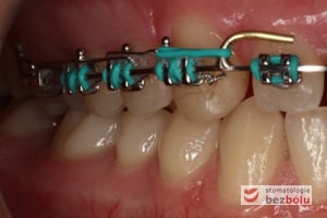 Łuk posted służący domykaniu luki