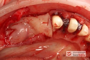 Miejsce implantacyjne wzbogacone o białkowe czynniki wzrostu podlega szybszemu procesowi gojenia