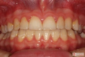 Warunki okluzyjne po leczeniu Warunki okluzyjne po leczeniu