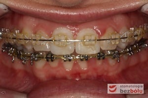 Końcowa faza leczenia - finishing