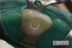 Ćwiek Fibre Core stanowiący podparcie dla wypełnienia kompozytowego zacementowany w kanale cementem kompozytowym Ćwiek Fibre Core stanowiący podparcie dla wypełnienia kompozytowego zacementowany w kanale cementem kompozytowym