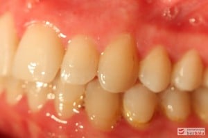 Warunki zgryzowe po leczeniu - strona lewa