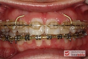 Zastosowanie łuków typu posted oraz retainera wyciągów poziomych w celu retrakcji odcinka przedniego