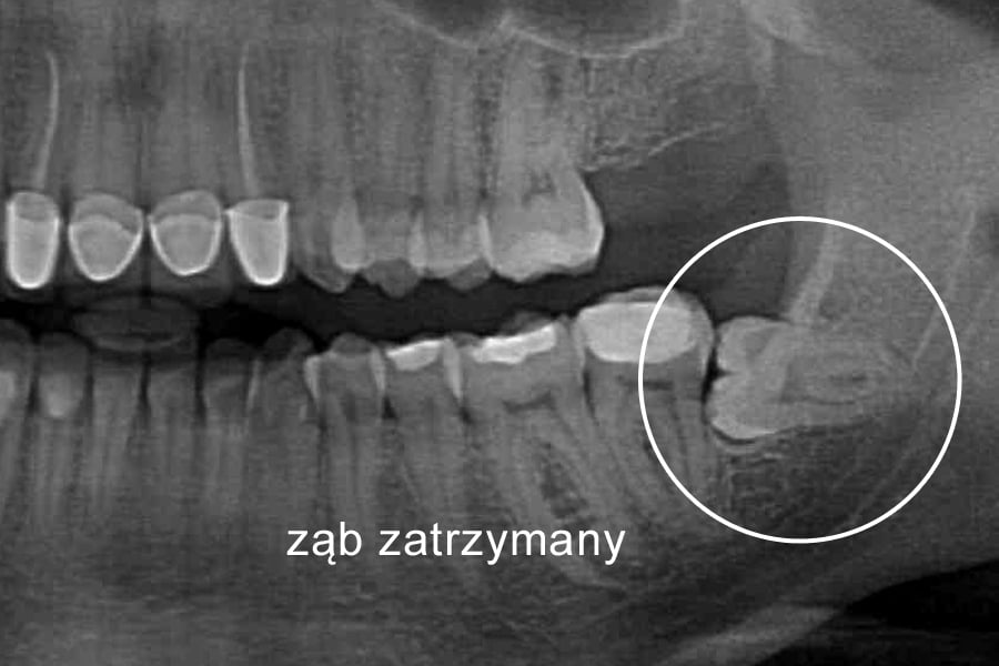 Ząb zatrzymany - warto wiedzieć Ząb zatrzymany - warto wiedzieć