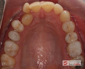 Łuk górny tuż przed założeniem pierwszego pozycjonera Łuk górny tuż przed założeniem pierwszego pozycjonera