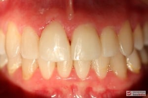 Warunki zgryzowe po leczeniu