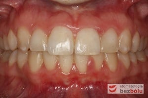 Zęby górne i dolne w zwarciu