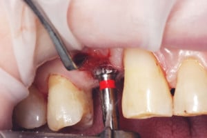Ostateczna preparacja łoża implantu
