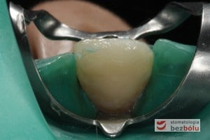 Ubytek od strony podniebiennej zaopatrzony ćwiekiem Fibre Core zamknięty materiałem kompozytowymUbytek od strony podniebiennej zaopatrzony ćwiekiem Fibre Core zamknięty od strony materiałem kompozytowym Ubytek od strony podniebiennej zaopatrzony ćwiekiem Fibre Core zamknięty materiałem kompozytowym