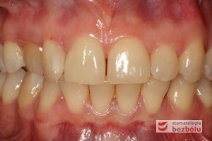 Widok od przodu - widoczny kieł od frontu Widok od przodu - widoczny kieł od frontu