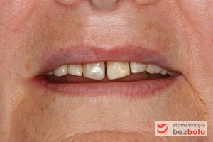 Pacjentka w wieku 65 lat - jasno sprecyzowane oczekiwania dotyczące terapii stomatologicznej Pacjentka w wieku 65 lat - jasno sprecyzowane oczekiwania dotyczące terapii stomatologicznej