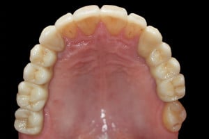 Ostateczna praca protetyczna – widok z powierzchni zgryzowej.