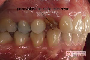 Strona prawa w okluzji Strona prawa w okluzji