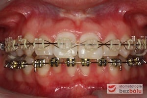 Aktywna faza leczenia z wykorzystaniem kosmetycznych zamków w łuku górnym i standardowych metalowych zamków w łuku dolnym